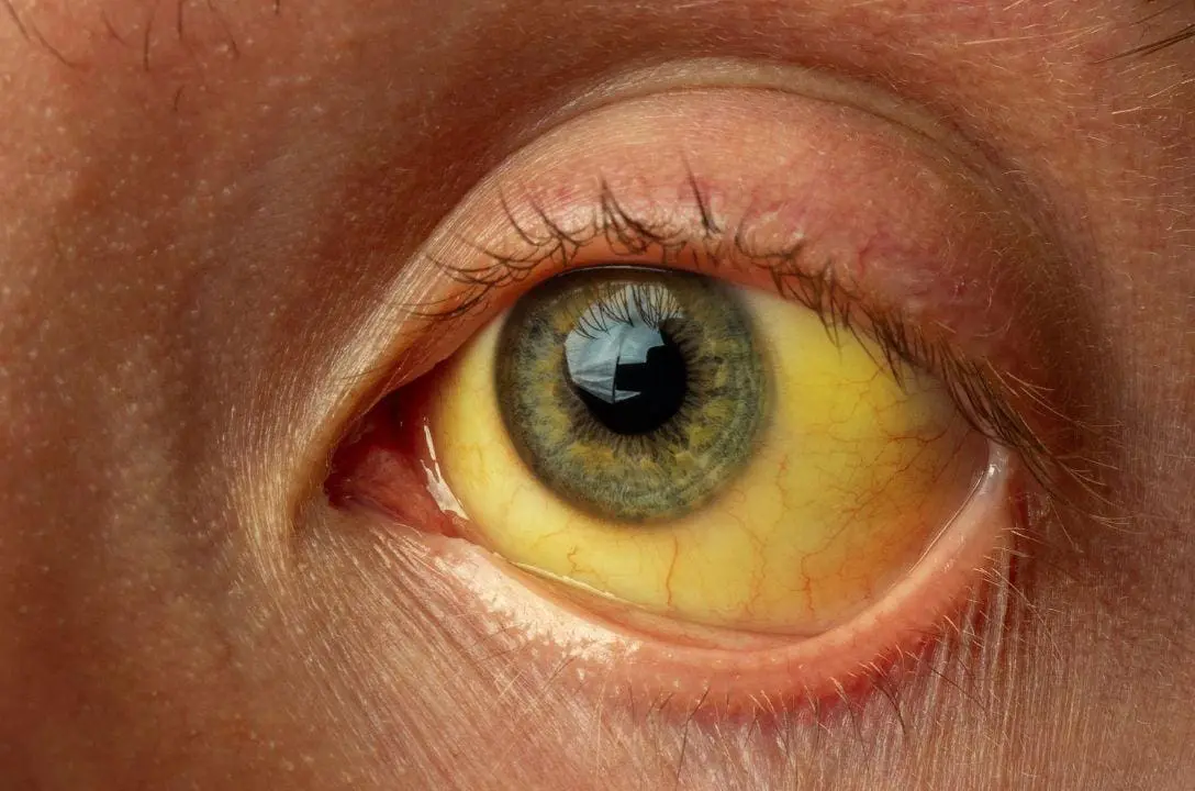 50x Mais Contagiosa Que o HIV - Você Conhece a Hepatite B?
