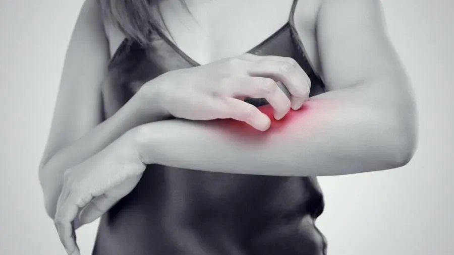 6 dicas infalíveis para aliviar picadas de inseto.