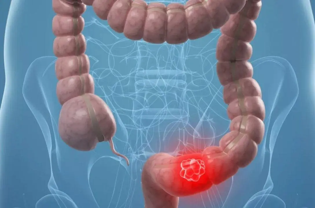 7 mil mortes por câncer de ânus - Saiba como se prevenir