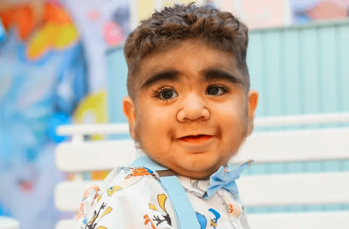 Bebê "barbudo" faz sucesso no TikTok devido à rara condição de hipertricose