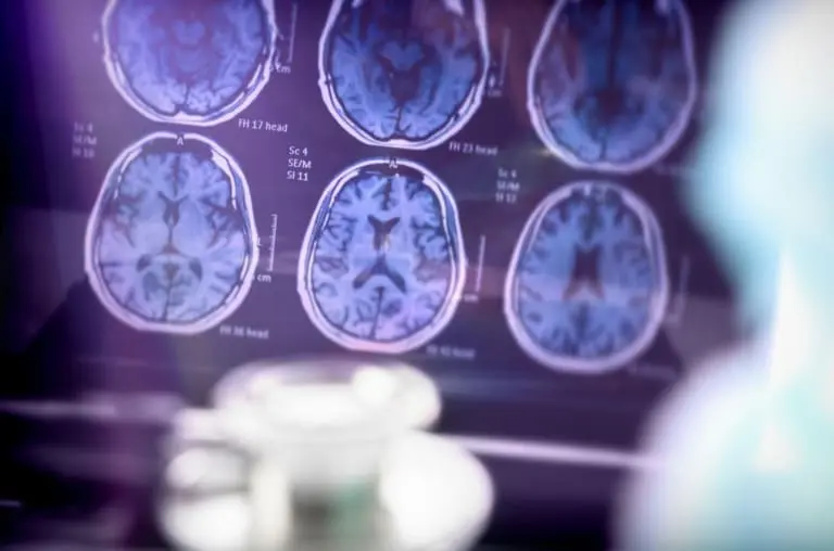 Cientistas brasileiros descobrem nova substância que pode tratar o Alzheimer