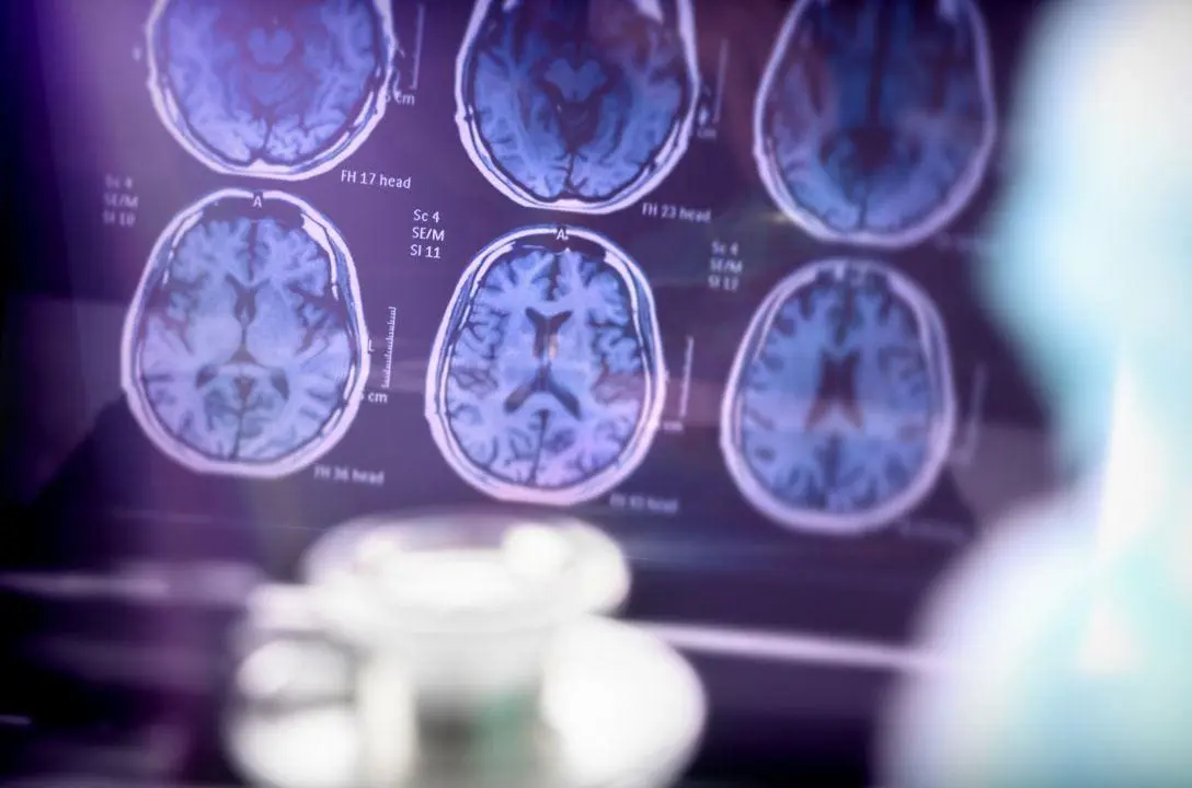 Cientistas brasileiros descobrem nova substância que pode tratar o Alzheimer