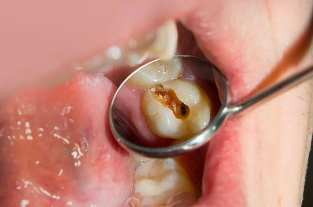 Cientistas criam gel que reconstrói dentes de forma natural