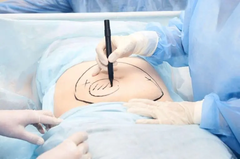 Como funciona a lipoaspiração