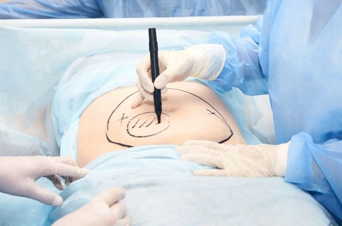 Como funciona a lipoaspiração