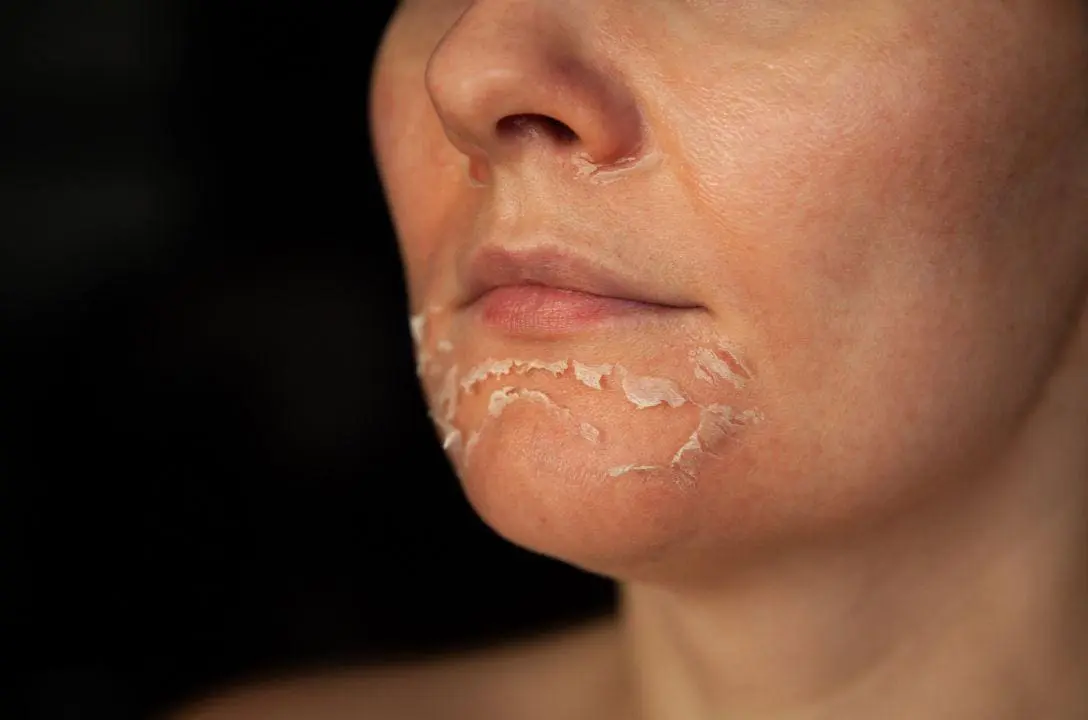 Entenda os perigos e precauções necessárias do tratamento com peeling de fenol