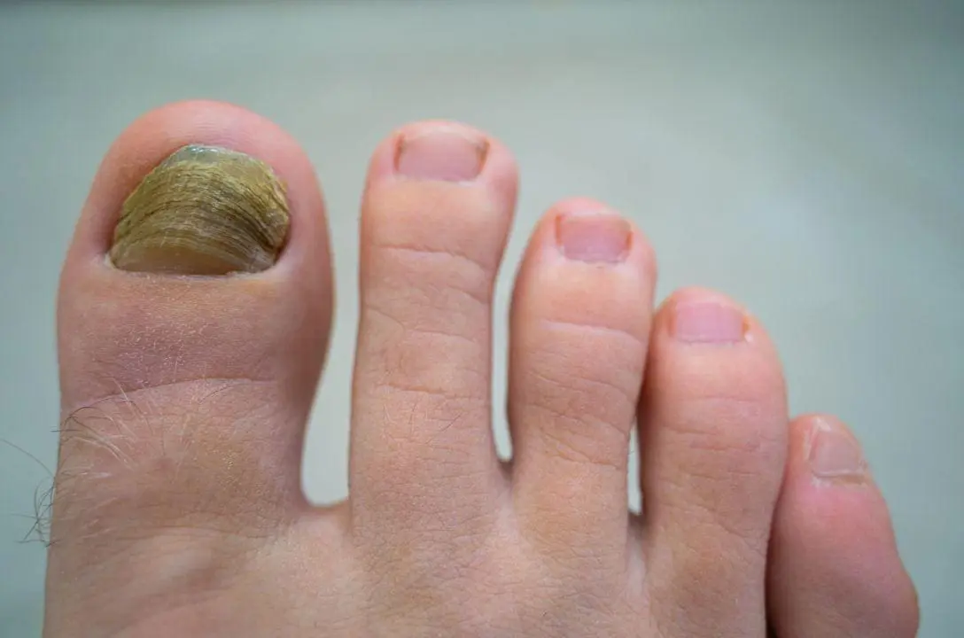 Essas alterações nas unhas podem indicar problemas de saúde