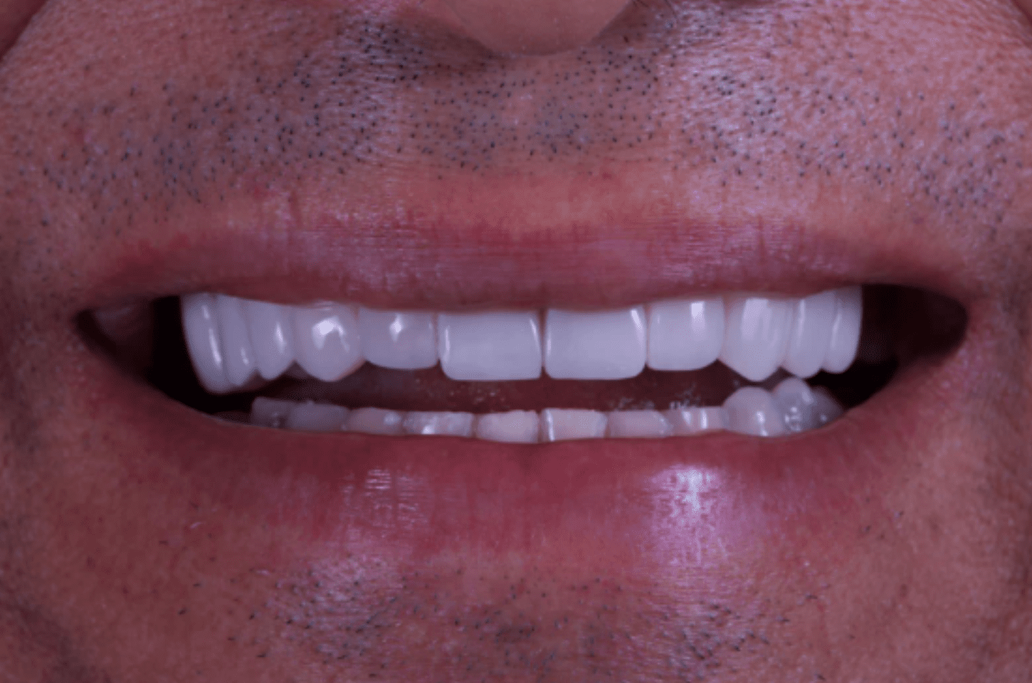 Facetas dentais: o segredo do sorriso perfeito pode esconder riscos