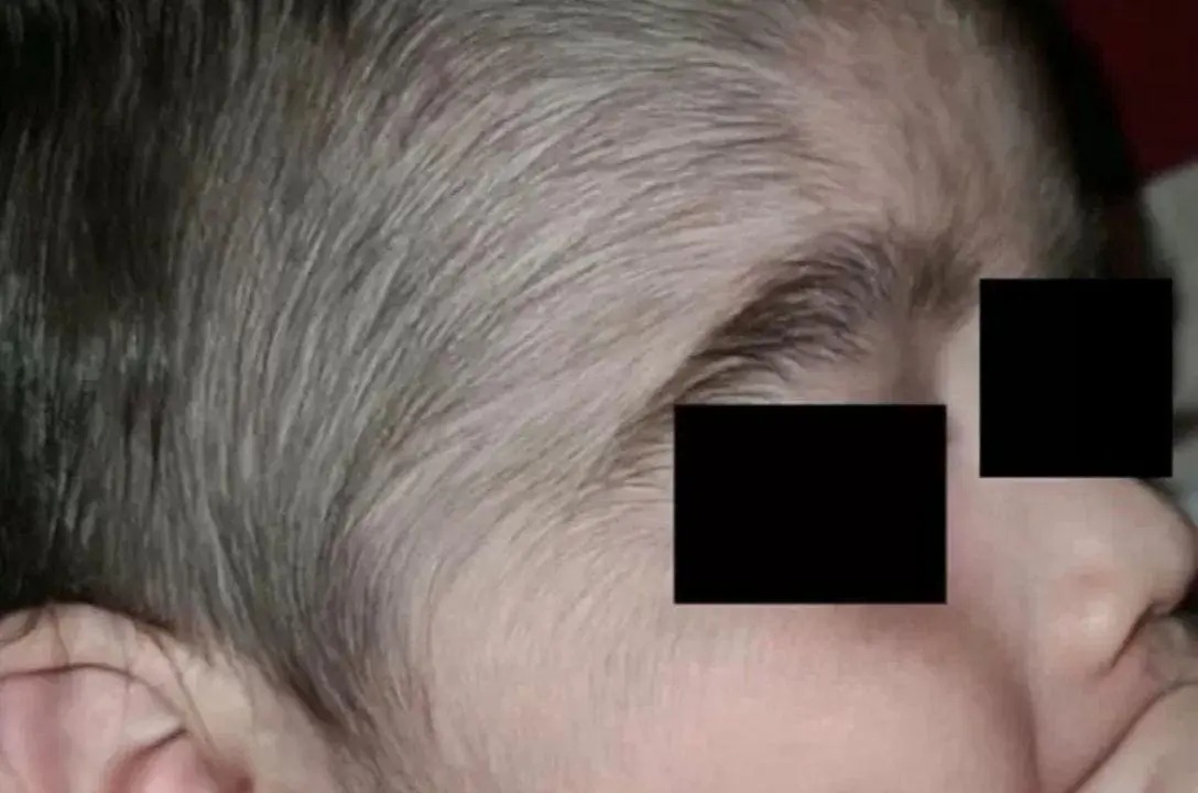 Minoxidil pode levar bebês à Síndrome de Lobisomem