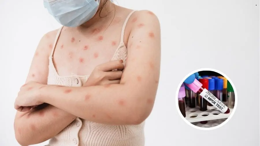 O que saber sobre a mpox, que já supera 80 casos no Brasil