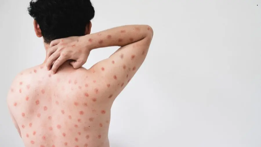 No Brasil, a Mpox voltou ao radar. O pa&iacute;s j&aacute; ultrapassou a marca de 80 casos confirmados em 2026
