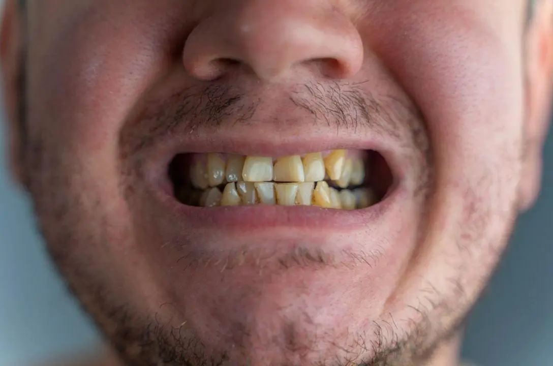 Não cuidar dos dentes pode causar infarto e outros problemas