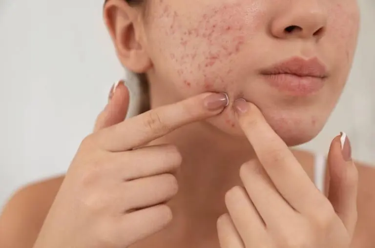 Será o fim da acne? Vacina francesa promete eliminar espinhas