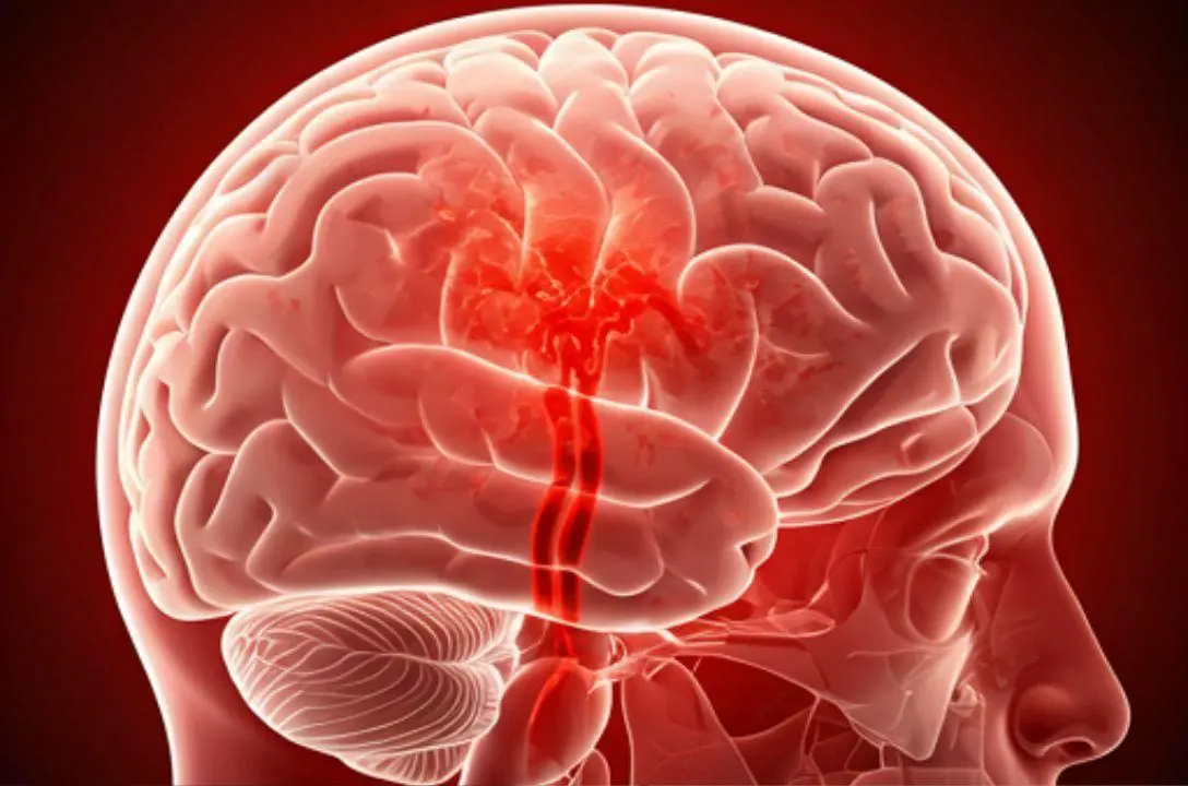 O que é hemorragia cerebral? Saiba quais são os sinais