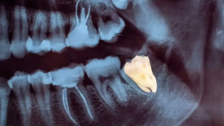 Os dentes do siso podem ser mais valiosos do que você imagina