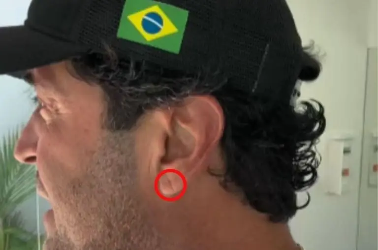 Sinal de Frank: linha na orelha pode indicar risco cardíaco?