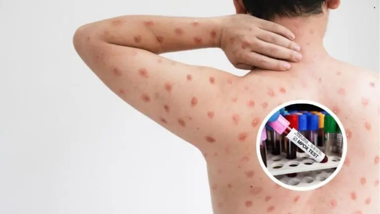 Surge nova variante da varíola mpox em 2 países, admite OMS