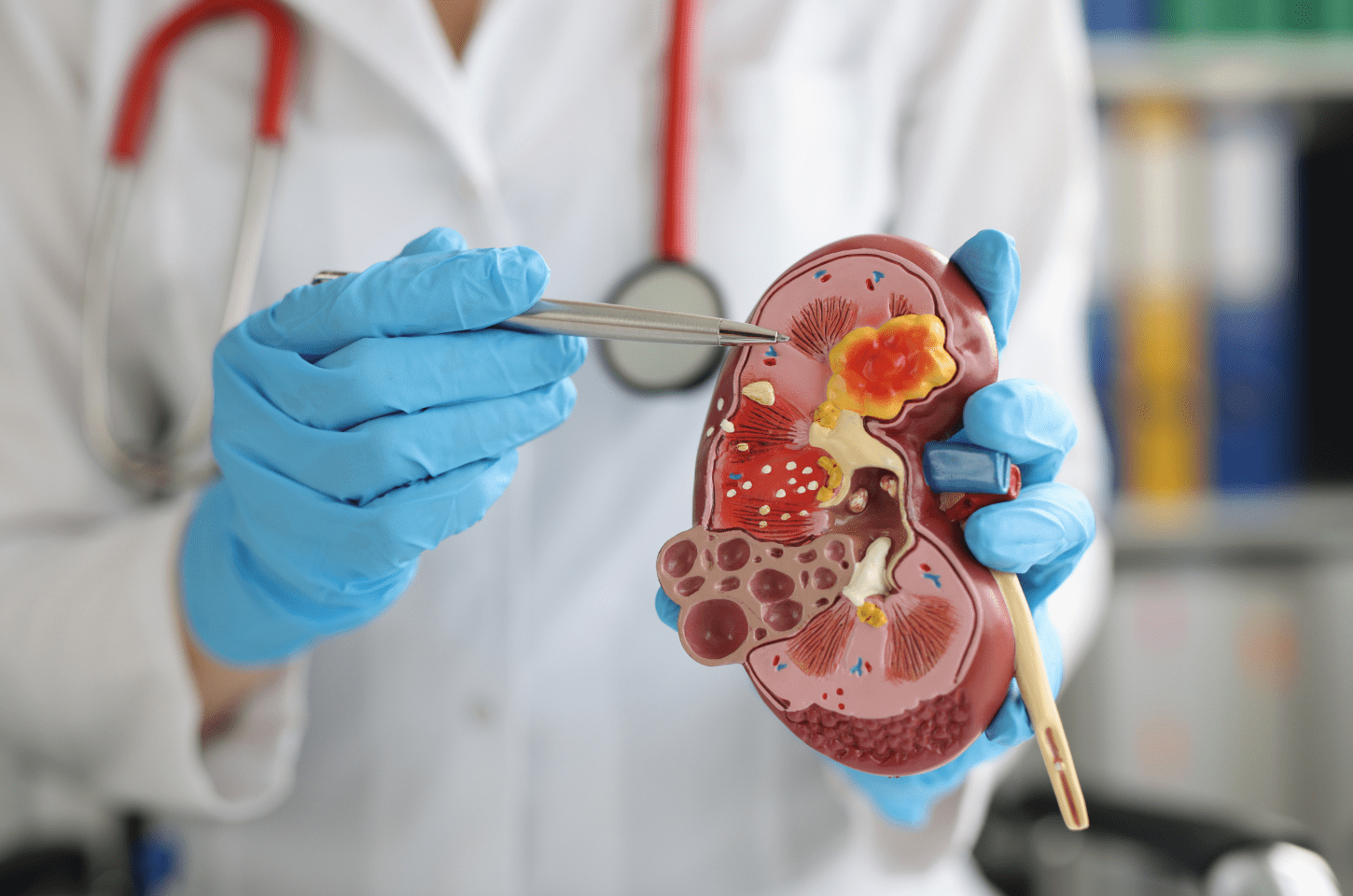 Transplante Renal: Procedimento que restaura a esperança de vida