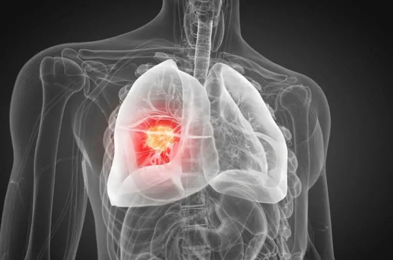 Vacina contra o câncer de pulmão entra em testes em 7 países