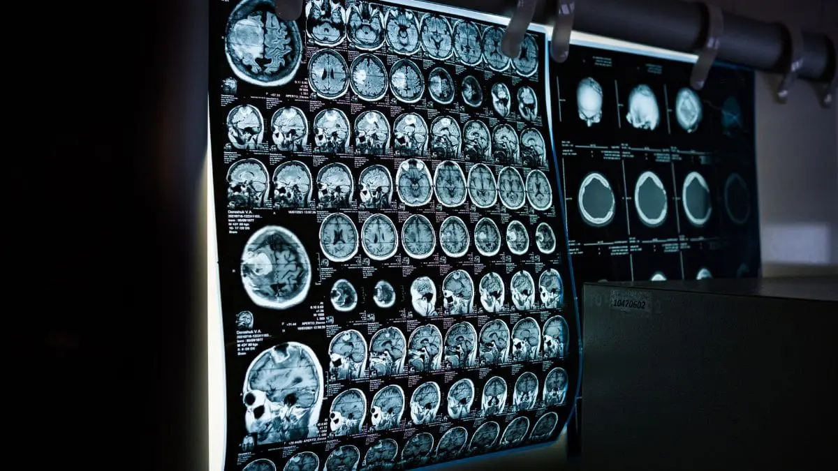 No momento, o uso das canetas emagrecedoras continua indicado para obesidade e diabetes, e n&atilde;o como tratamento para Alzheimer.