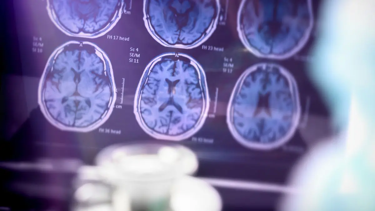 Cogumelos com psilocibina melhoram fala e autonomia de idosa com Alzheimer Embora o relato tenha chamado atenção internacionalmente, os próprios autores pedem cautela na interpretação dos resultados.
