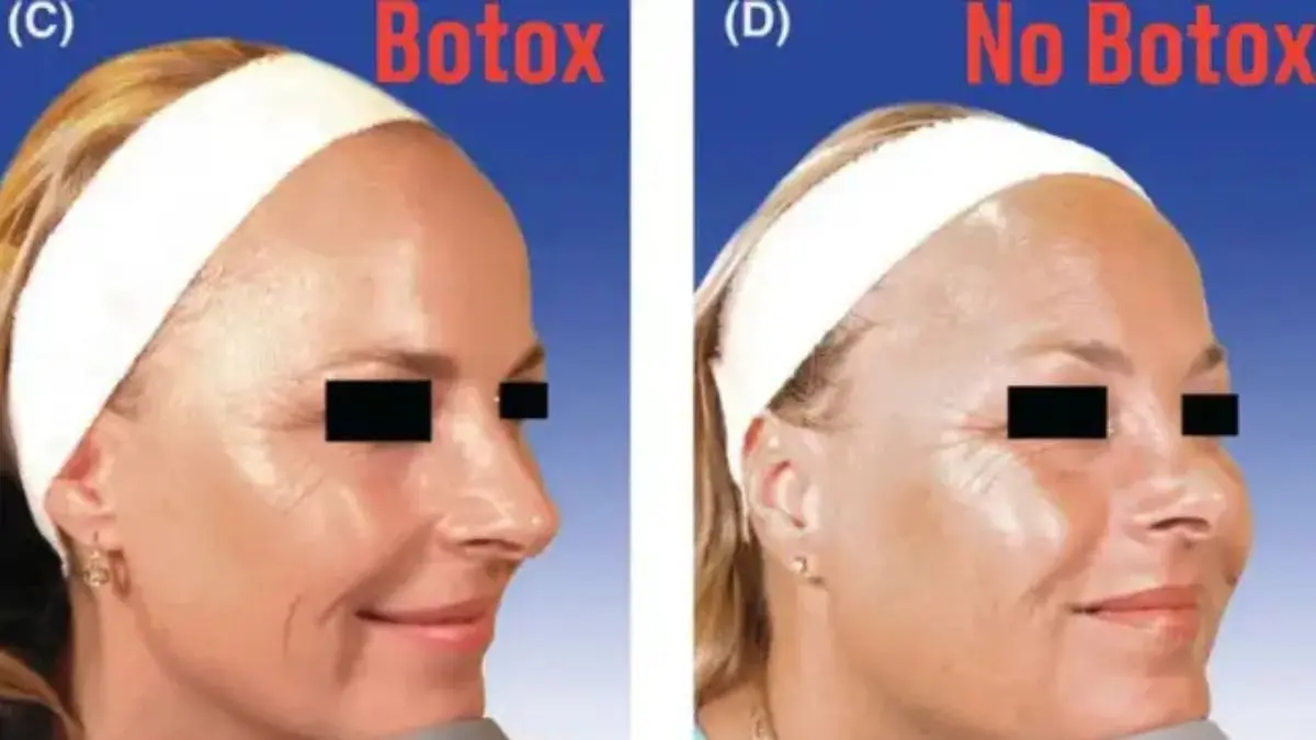 Mesma genética, mesma idade e rostos extremamente parecidos. Depois de décadas com rotinas diferentes de Botox, as diferenças começaram a aparecer justamente nas regiões tratadas.