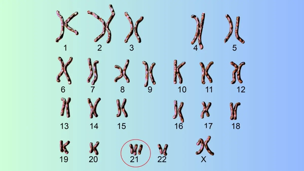 Cientistas conseguiram remover cromossomo ligado à síndrome de Down A síndrome de Down, também chamada de trissomia 21, geralmente ocorre quando as células apresentam três cópias do cromossomo 21, em vez de duas