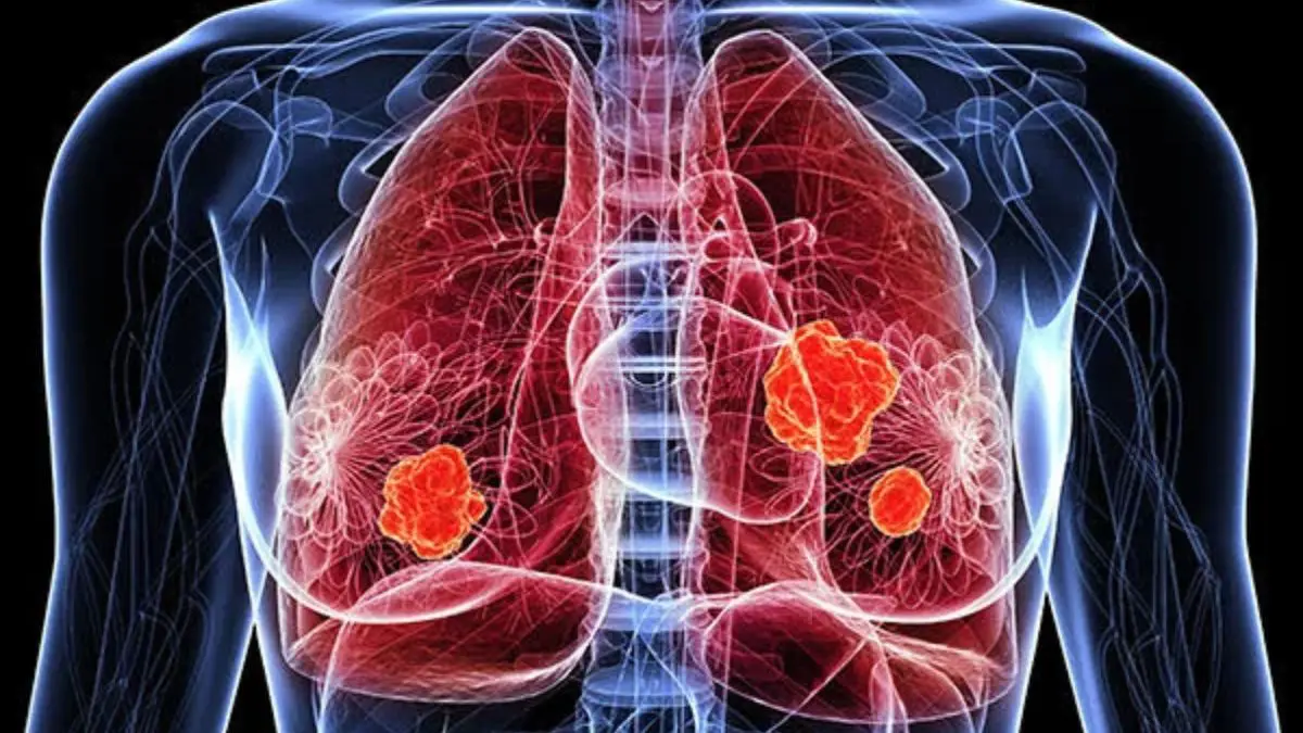 Câncer de pulmão do Papa alerta para aumento da doença em não fumantes O câncer de pulmão pode não provocar sintomas perceptíveis no início. Quando surgem manifestações, elas podem se parecer com as de outras condições respiratórias