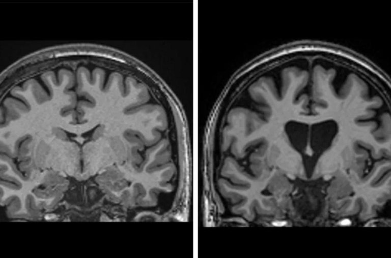 Doença de Huntington foi tratada com sucesso pela 1ª vez