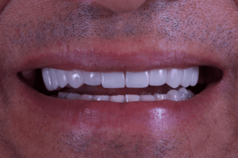 Facetas dentais: o segredo do sorriso perfeito pode esconder riscos