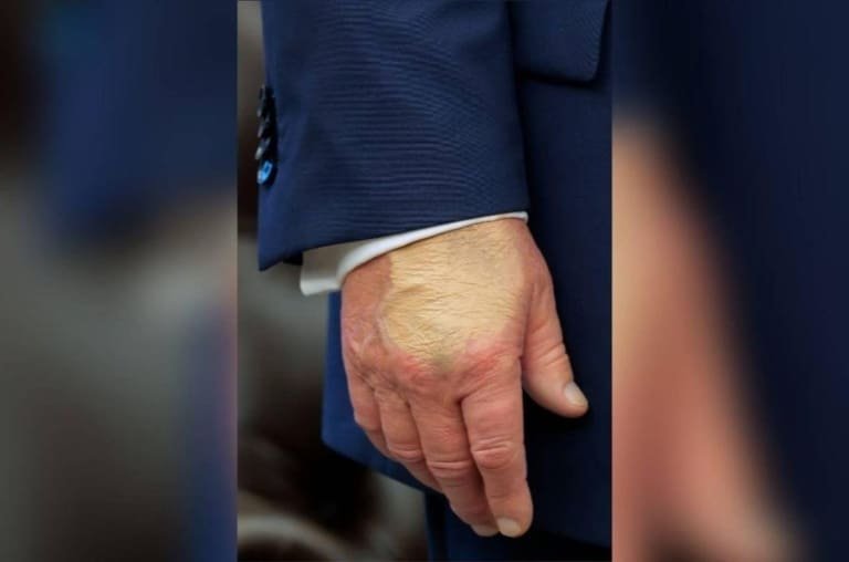 Insuficiência venosa crônica, condição que afeta mãos de Trump