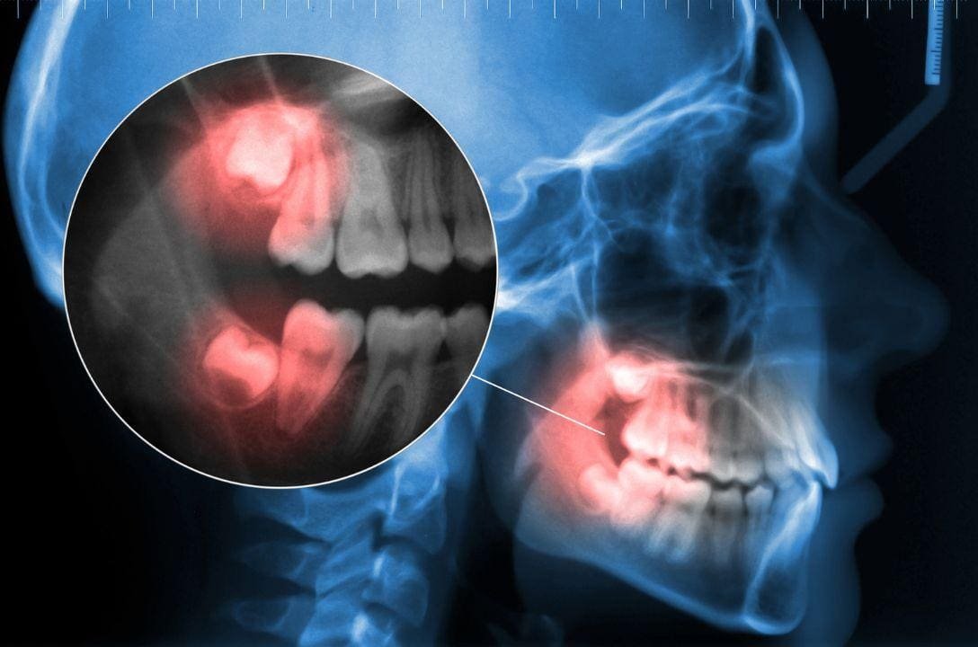 Mitos e verdades sobre os riscos da cirurgia do dente siso