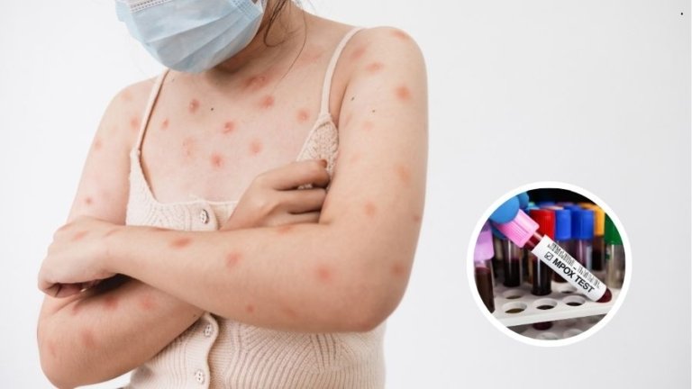 O que saber sobre a mpox, que já supera 80 casos no Brasil