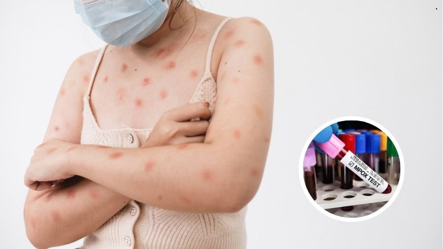 O que saber sobre a mpox, que já supera 80 casos no Brasil