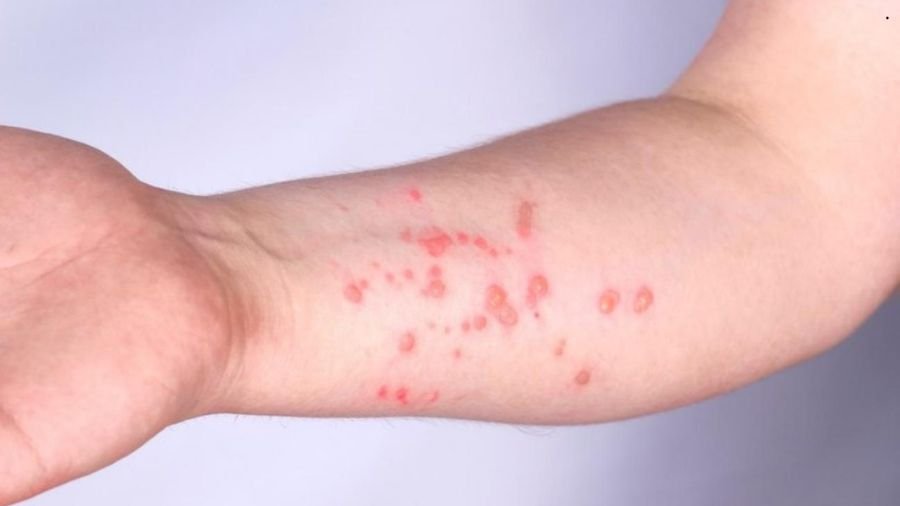 A Mpox exige proximidade f&iacute;sica para a transmiss&atilde;o, o que limita sua dissemina&ccedil;&atilde;o em larga escala