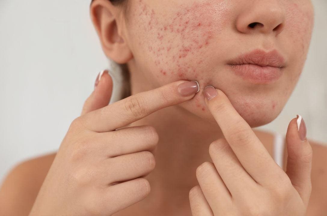 Será o fim da acne? Vacina francesa promete eliminar espinhas