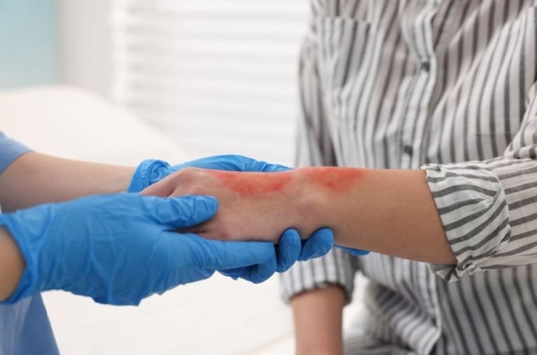 Quais são os tipos de queimadura? Como tratar cada um deles?