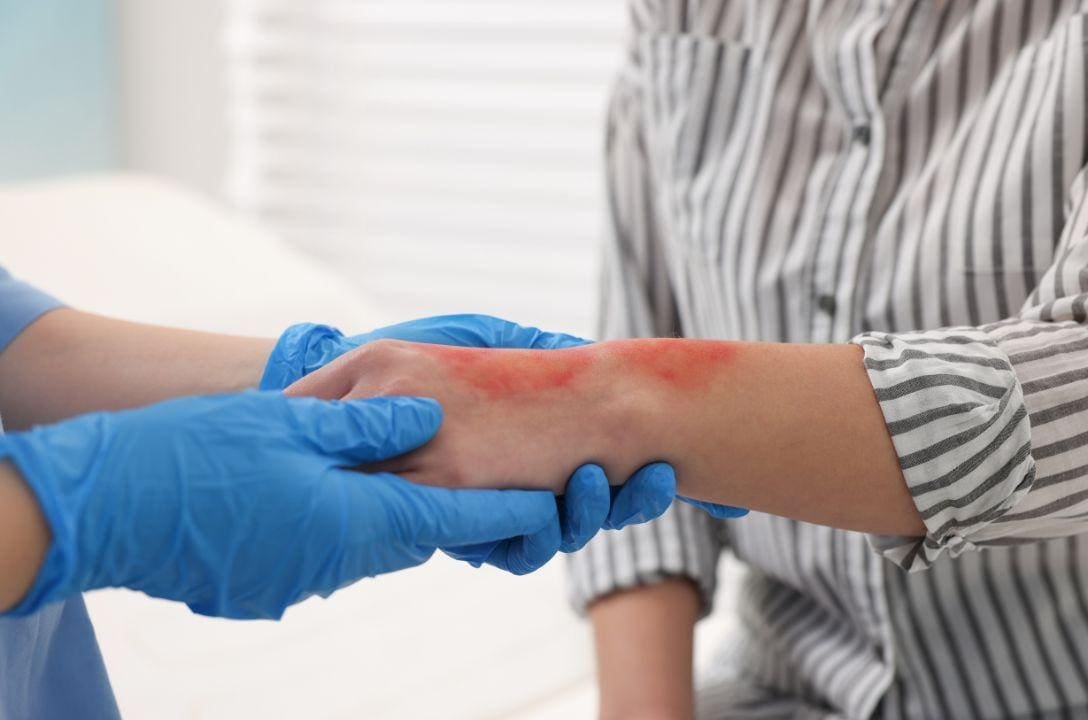 Quais são os tipos de queimadura? Como tratar cada um deles?