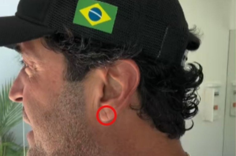 Sinal de Frank: linha na orelha pode indicar risco cardíaco?