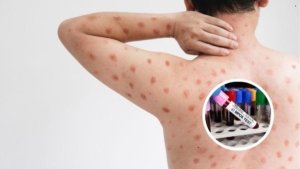 Surge nova variante da varíola mpox em 2 países, admite OMS