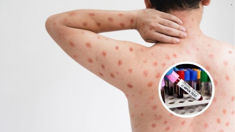 Surge nova variante da varíola mpox em 2 países, admite OMS
