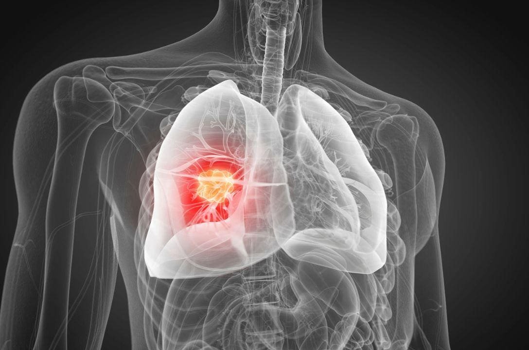Vacina contra o câncer de pulmão entra em testes em 7 países