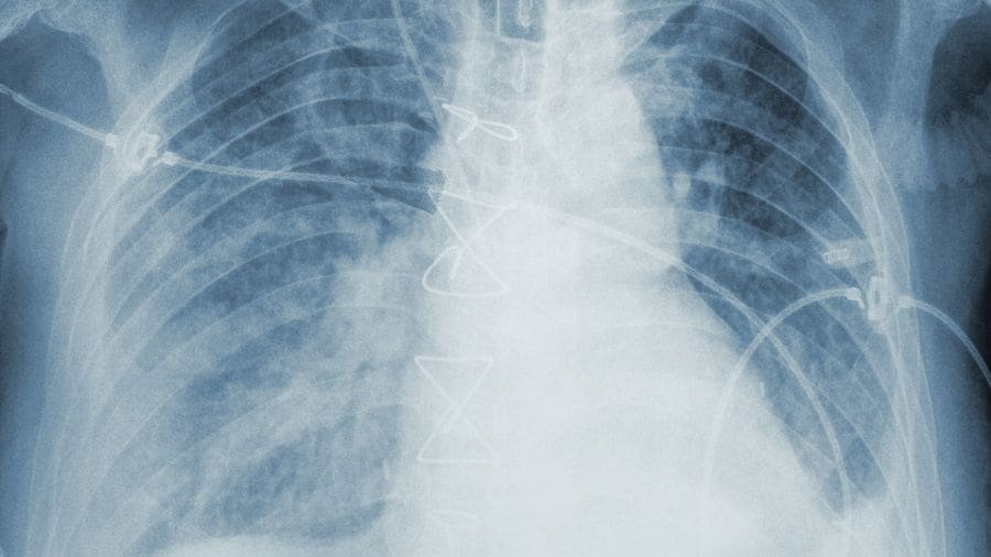 Nem todos os casos de broncopneumonia bacteriana evoluem para situa&ccedil;&otilde;es cr&iacute;ticas