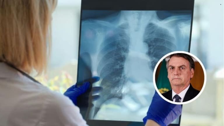 Broncopneumonia bacteriana: doença que afeta Bolsonaro