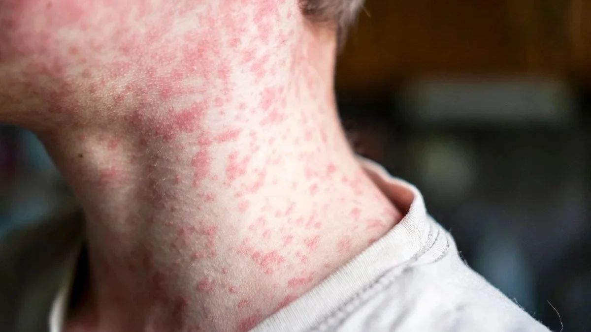 Surto de sarampo em Nova York: entenda a declaração de estado de emergência